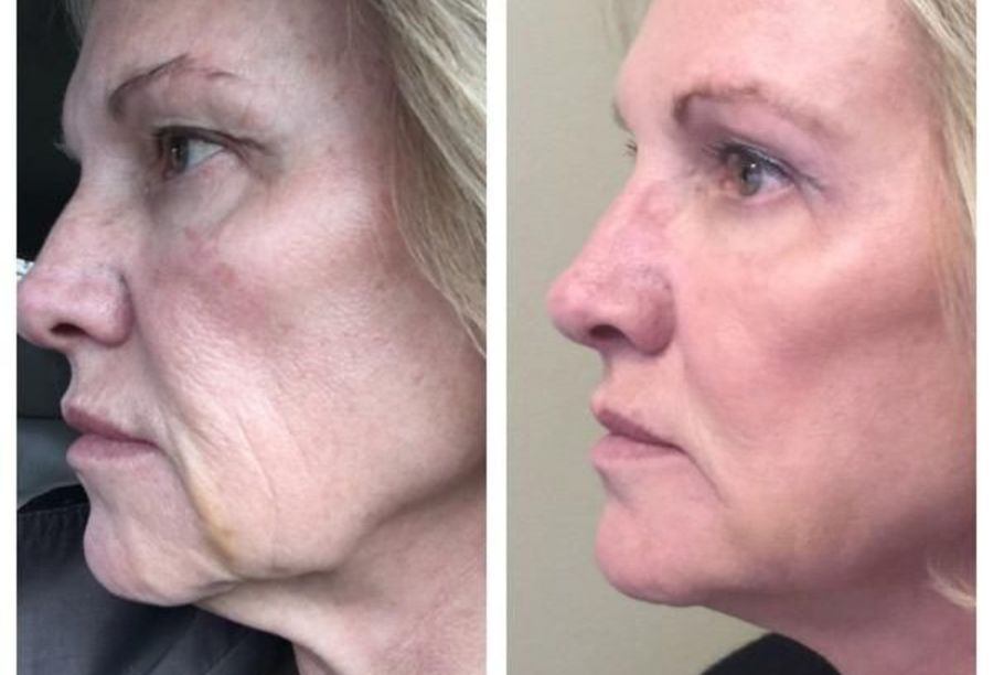 Before / After